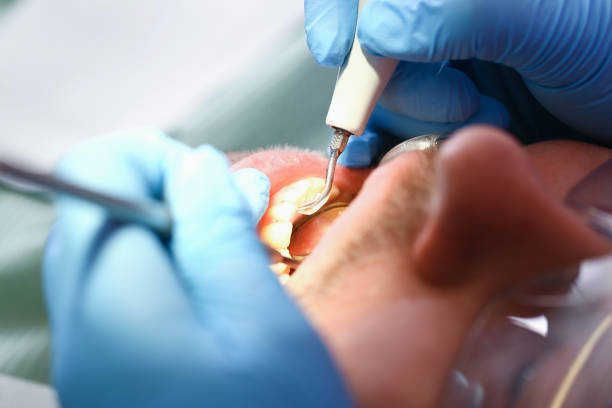 Urgent Tooth Repair in WA