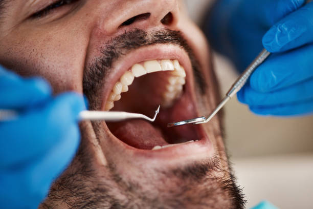 Best Chipped Tooth Repair Near Me  in Sudden Valley, WA